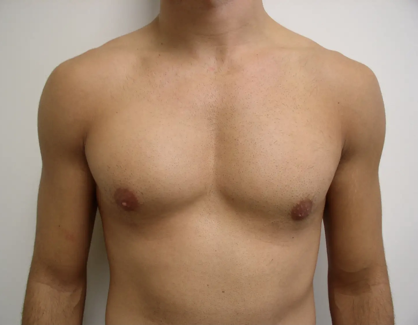шишка в левой груди у мужчин фото 87